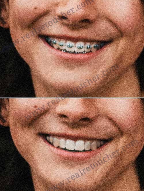 Teeth-retouching