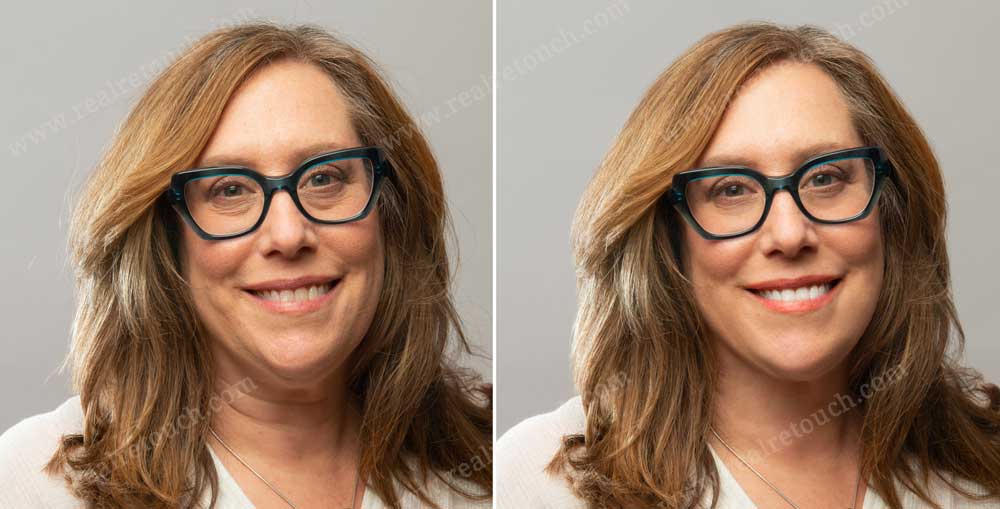 double-chin-removal